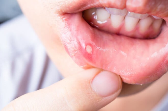 Phải chăng trời nắng nóng xảy ra hiện tượng nhiệt miệng?